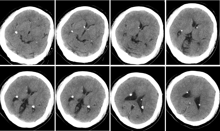 李x，反复发作性意识障碍伴肢体抽搐20余年