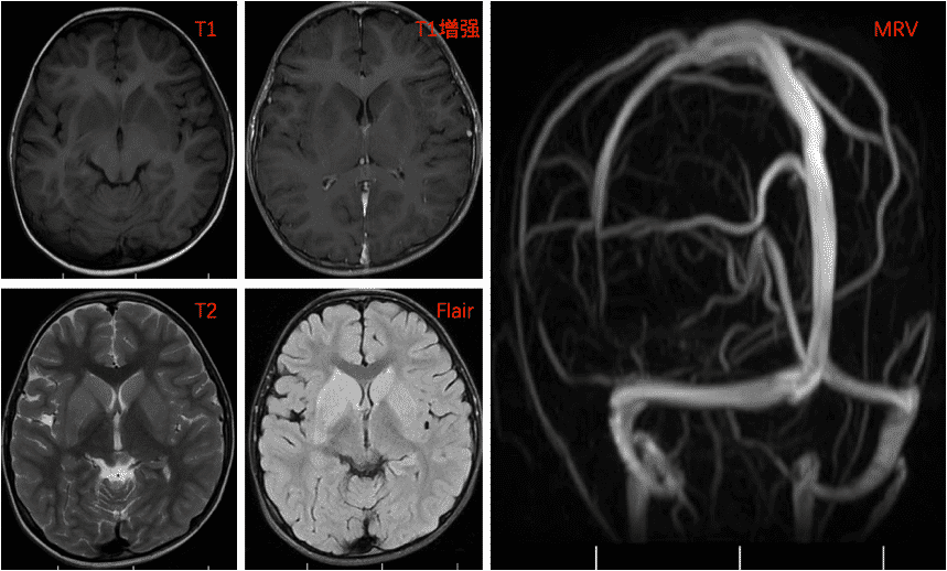 周x，发热、精神偏差伴头晕、呕吐5天