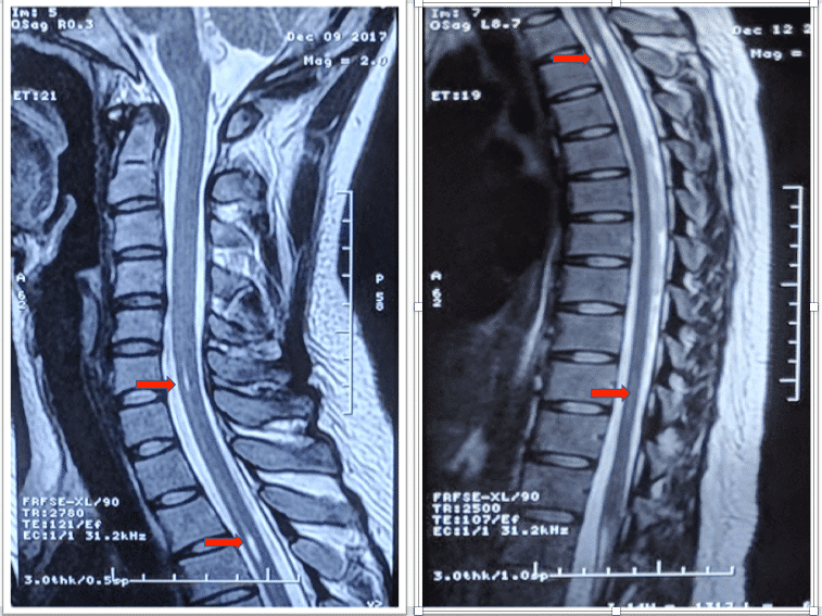 杜x，颈背部疼痛9月，双上肢麻木伴无力8月