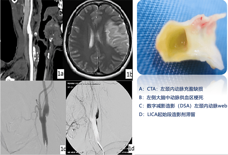 李x，突发头痛、言语不利伴右侧肢体活动障碍1小时