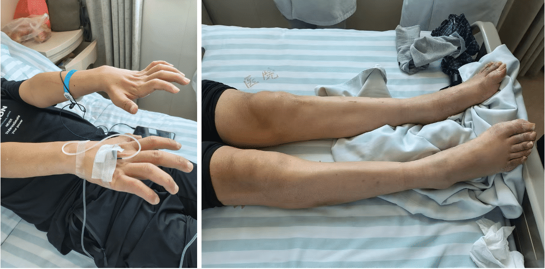  宋x，慢性进展性双下肢无力伴肌肉萎缩3年