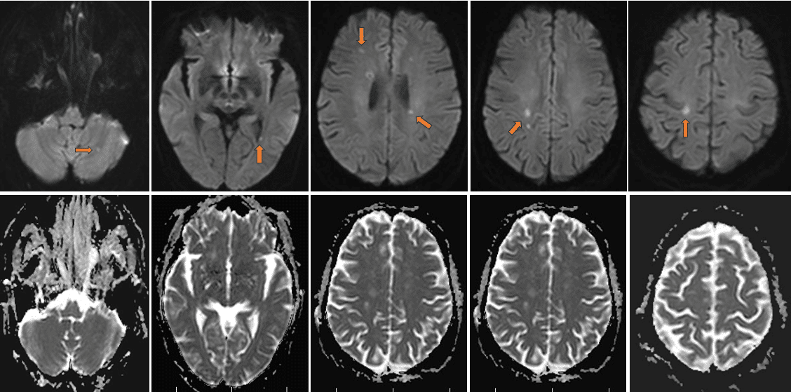 靳x，言语不清伴肢体无力3天