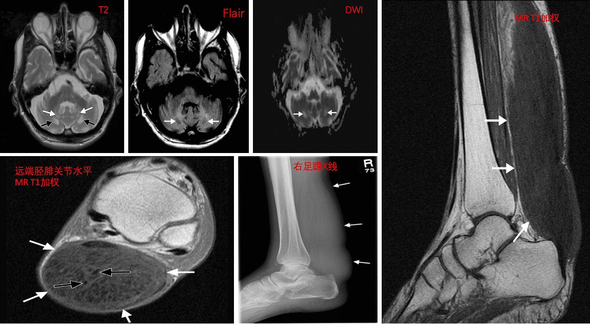 祁x，40y，进行性行走困难伴平衡障碍2年