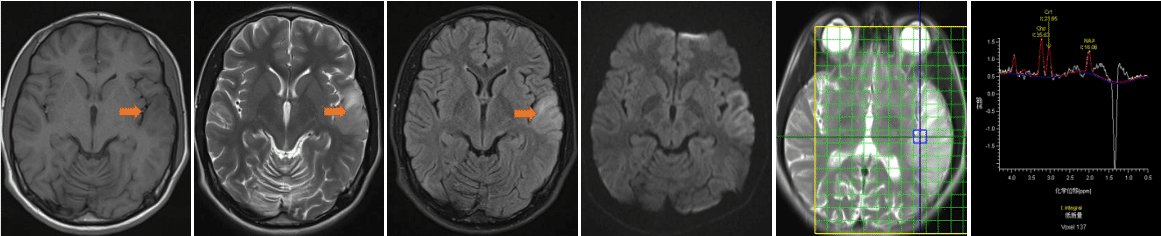吕x，左耳闷堵感伴言语不清2天