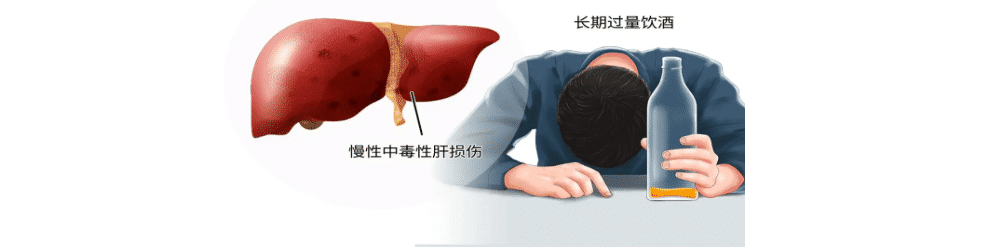 酒精 & 肝硬化